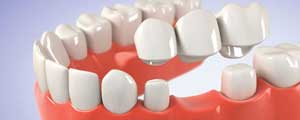 ترکیبات دندان سازی